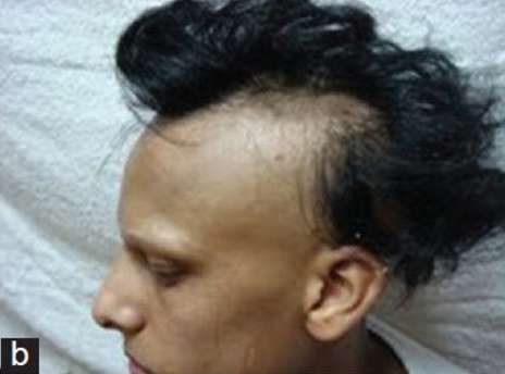 Alopecia areata 01