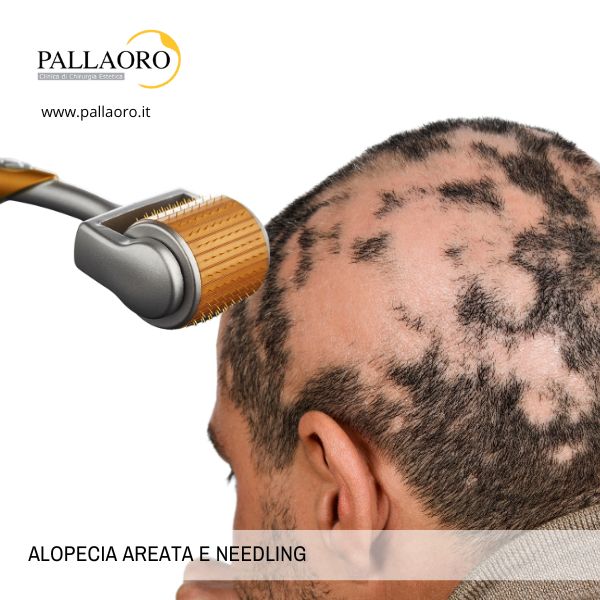 alopecia areata needling