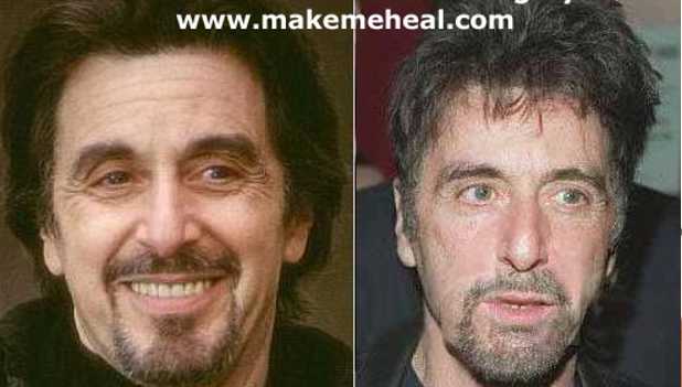 chirurgia estetica vip Al Pacino