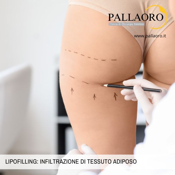 lipofilling infiltrazione di tessuto adiposo