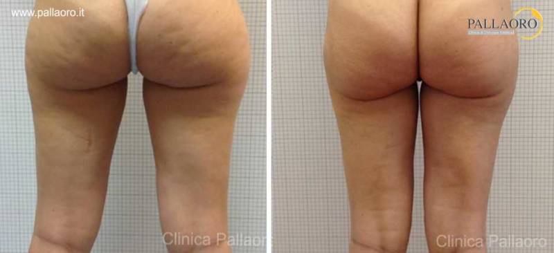 liposuzione cosce glutei gambe 00