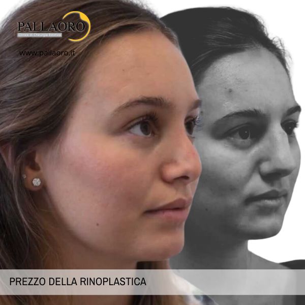 prezzo della rinoplastica