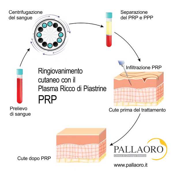 prp viso procedura