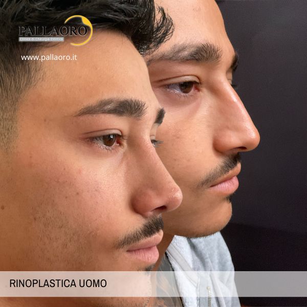 rinoplastica uomo