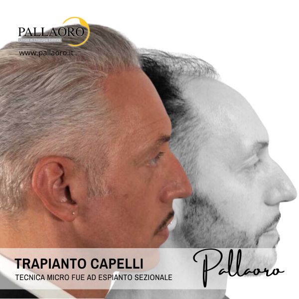 trapianto capelli prima dopo 