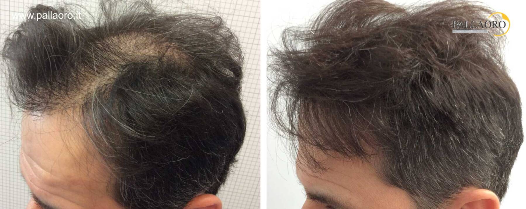 trapianto capelli cicatrice post fut diastasata sinistra