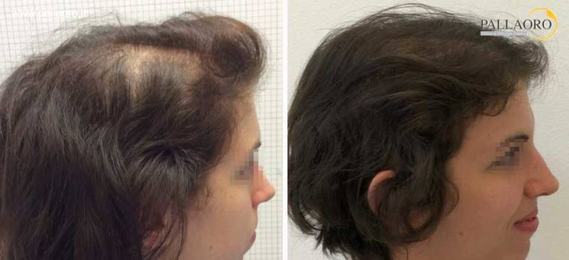 Trapianto capelli Micro FUE HD su alopecia androgenetica femminile