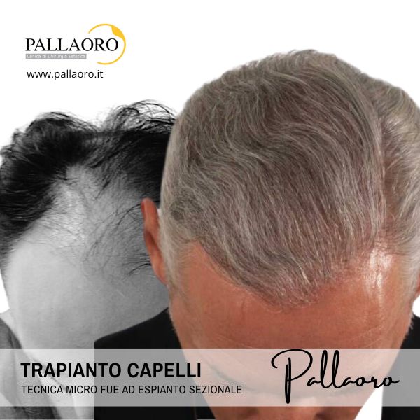 trapianto capelli milano