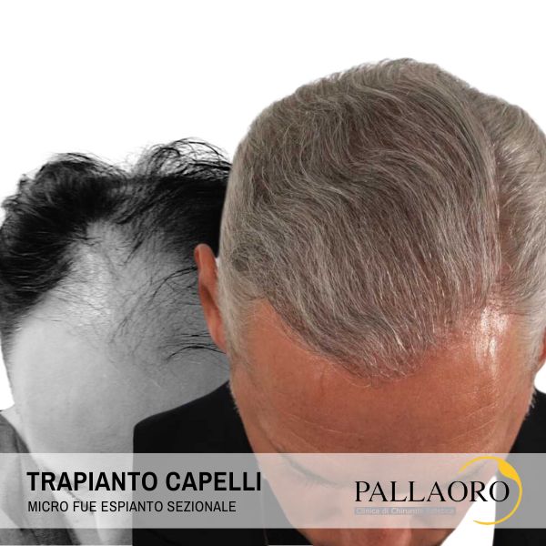 trapianto capelli livorno