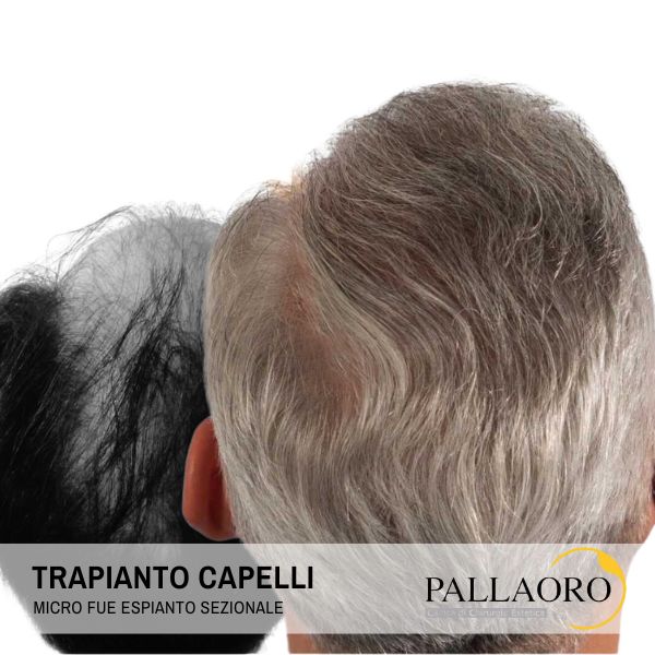 Trapianto capelli Mestre