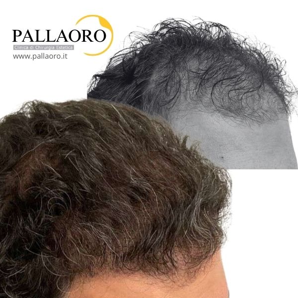 trapianto capelli torino